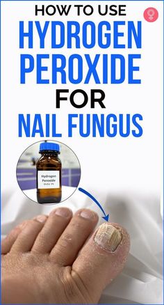 Toenail Fungal Infection, Fingernail Fungus