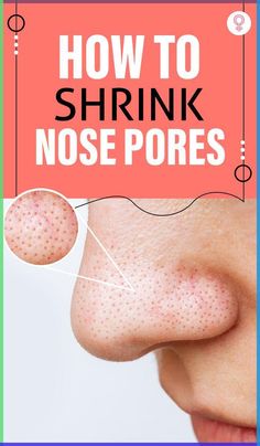 Enlarged nose pores can look unsightly. They can disrupt your overall look and may grow in size over time. However, here’s the thing – you can cleanse, unclog, and shrink them with a little upkeep and the correct home remedies. #skincare #skincaretips #largepores #beauty #beautytips Large Pores On Nose, Clean Nose Pores, Big Pores, Nose Pores, Deep Clean Pores, Smaller Pores, Brown Spots Removal, Reduce Pores, Clear Skin Tips