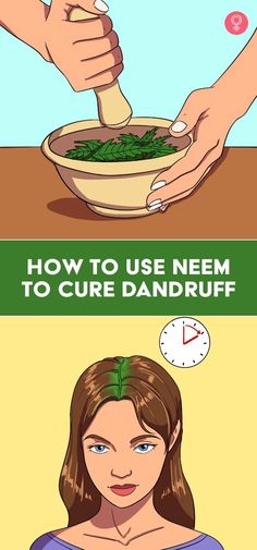 How To Use Neem To Cure Dandruff: Dandruff is a common hair problem and may keep recurring. But fret not – as neem for dandruff may help. The misconception that dandruff is caused due to poor hygiene may cause social embarrassment in many. How Remove Dandruff Hair, How To Get Rid Of Dandruff Fast At Home, Natural Remedy For Dandruff, Anti Dandruff Hair Mask, Dandruff Remedy Severe, Neem Hair Mask For Dandruff, Remove Dandruff Home Remedies, How To Prevent Dandruff, Hair Oil For Dandruff