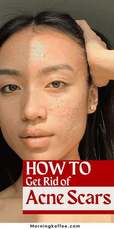 Acne Scaring, Face Mapping Acne, Acne Prone Skin Care