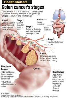 Lung Detox, Colon Health, Medical Knowledge, Types Of Cancers, Health Matters, Health Remedies, Home Remedies, Natural Remedies, Health Tips