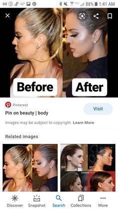 Chin Filler, Facial Fillers, Facial Contouring, Summer Wedding Outfit Guest, Dresses To Wear, Chicken Thigh Recipes, Diy Couture, Beauty Body, Dresses To Wear To A Wedding