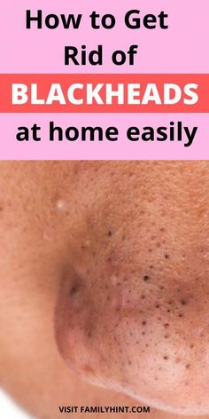 Just Rub Your Skin With This Spice Blackhead Remedies, To Remove Blackheads, Blackheads On Nose, Rid Of Blackheads, Reading More, Blackheads Removal, Cold Medicine, Skin Natural Remedies, Cold Sores Remedies