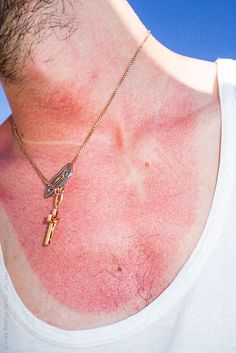 a man with red spots on his chest wearing a gold cross necklace and white tank top