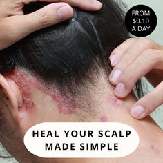 Stop Your: Itching, Sores, Scabs, Dandruff and Psoriasis - Get 10-Day Sample Kit for $9.95 Only Today! Sesak Nafas, Natural Facial Mask, Dark Circles Under Eyes, Skin Disorders, Happy Hair, Hair Scalp