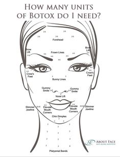 Botox Forehead, Botox Injection Sites, Botox Facial, Facial Injections, Botox Brow Lift, Botox Before And After, Botox Lips, Aesthetic Dermatology, Facial Anatomy