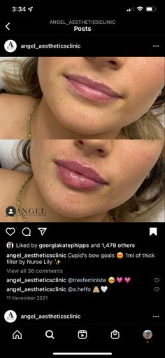 Hailey Beiber Lips Before And After, Lip Filler Before And After Round Lips, Natural Looking Filled Lips, Small Lip Injections Before And After, Light Lip Injections, Lip Fuller Shapes, M Shape Lips, Lip Fillers Cupids Bow, Lip Filler Inspiration Heart Shaped