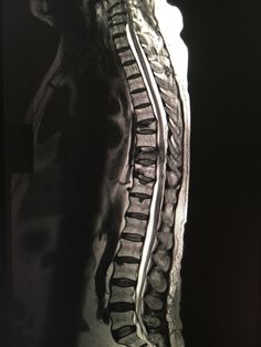 an x - ray image of the back of a man's neck and ribs