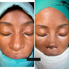 @dr.ahmetalp Ethnic Nose Job, Nose Goals, Closed Rhinoplasty, Books Summary, Facial Balancing