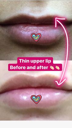 Perfect Lips Injections, Key Hole Lips Injections, Juvederm Lips 1 Syringe, Botox And Fillers, Lip Injections Before And After 0.5ml, Under Eye Fillers, Facial Plastic Surgery