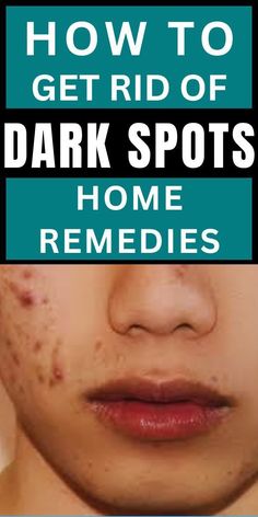 Dark Spots Remove With These Natural Ways Lemon Juice Uses, Brown Spots On Face, Younger Skin