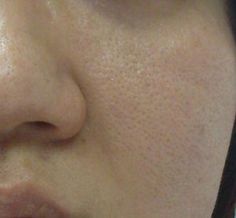 Home Remedies for Enlarged Pores-Your face is met with many different obstacles, including maintaining the size of your pores. Thankfully, home remedies for enlarged pores can help improve the overall appearance of your skin #skin #remedies Open Pores On Face, Pores On Face, Get Rid Of Pores, Big Pores, Reduce Pore Size, Acne Overnight, Open Pores, Skin Care Face, Reduce Pores