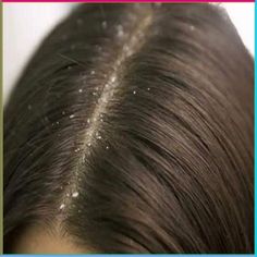 Blond Cenușiu, Dandruff Causes, Hair Lice, Premature Grey Hair, Oil For Curly Hair, Regrow Hair Naturally, Coconut Oil Hair Growth