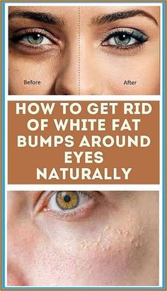 How To Get Rid of White Fat Bumps by dorothy Smith | This newsletter was created with Smore, an online tool for creating beautiful newsletters for educators, businesses and more Bumps Under Eyes, Under Eyes, Skin Care Treatments, Skin Problems, Bump, Beauty Skin, Natural Remedies