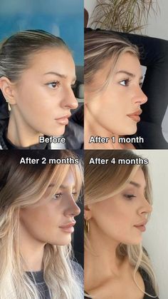 #plasticsurgery #plasticsurgerygonewrong #beforeafter #celebritiesbeforeafter #hollywoodstars #bignosesurgery #surgery #facesurgery #vlinesurgery #koreanplasticsurgery #kpopplasticsurgery #nosejob #jawreductionsurgery #eyesurgery #cheekfillers #rhinoplasty #facelift #plasticsurgeryfails #expensiveplasticsurgery #viral Rhinoplasty Recovery Tips, Kpop Plastic Surgery, Jaw Reduction Surgery, Rhinoplasty Recovery, V Line Surgery, Plastic Surgery Fail, Korean Plastic Surgery, Rhinoplasty Before And After