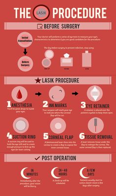 Infographic on what to expect before, during and after the LASIK procedure. #Infographic #LASIK Swollen Eyes, Irritated Eye, Eye Center