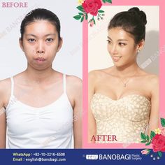 Ponytail Lift, Body Surgery, Chin Augmentation