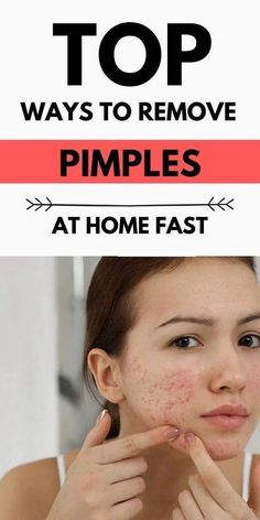 One of the most frustrating skin problems that can occur in both men and women is pimples. It can be embarrassing, especially if it occurs in the face. A lot Remedies For Pimples, Get Rid Of Pimples Overnight, Rid Of Pimples Overnight, Pimples On Buttocks, Seasonal Skincare, Spf Cream, Home Remedies For Pimples, Get Rid Of Pimples