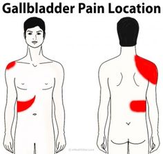 Gallbladder Removal Diet, Gallbladder Symptoms, Gallbladder Attack, Gallbladder Cleanse, Gallbladder Diet, Gallbladder Surgery, Kidney Pain, Gall Bladder, Referred Pain