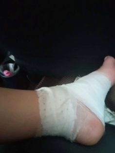 a person with bandages on their feet in a car