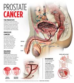 Prostate Surgery, Health Posters, Urinary System, Frequent Urination, Kegel Exercise, Care Hospital, Types Of Cancers, Love Is, Mens Health