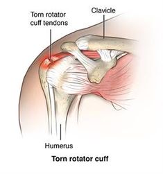 Types Of Surgery, Head Pain, Decrease Inflammation, Muscle Weakness