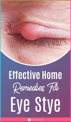 26 Effective Home Remedies To Get Rid Of Eye Stye: If there is a small, red bump near the base of the eyelash, it can be an eye stye. This causes great discomfort and an unsightly appearance. It is quite common to suffer from a stye in the eye once in a lifetime. But, there is nothing to worry about as this eye ailment can be easily treated. #remedies #homeremedies #eyestye Stye Remedy, Home Health Remedies, Cold Home Remedies, Natural Cough Remedies, Cough Remedies, Homemade Remedies, Natural Health Remedies, Natural Home Remedies