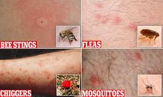 First aid expert reveals her ultimate guide to common bites and stings Types Of Bug Bites, Wasp Sting Remedy, Remedies For Bee Stings, Get Rid Of Bed Bugs, Medical Things, Medical Report, Ant Bites, Sting Relief, Wasp Stings