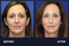 Fat Transfer Before & After Pictures | Madnani Facial Plastic Surgery Facelift Procedure, Sagging Neck, Laser Skin Resurfacing, Medical Theme, Eyelid Lift, Fat Transfer