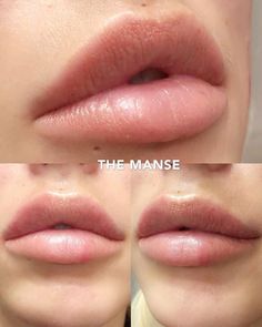 Lip Fillers Shapes, Keyhole Lips, Lip Injections Juvederm, Lip Plastic Surgery, Lip Fillers Juvederm, Lip Goals, Lip Ideas, Juvederm Lips, Lip Surgery