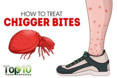 Red Bug Bites, Home Remedies For Rashes, Red Bugs, Bug Bite, Asthma Relief, Top 10 Home Remedies, Allergy Remedies