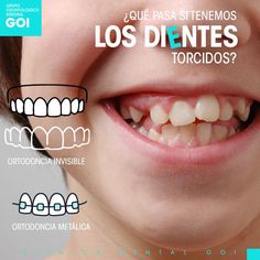 Muchas personas creen que el problema de los dientes torcidos es solamente estético y no es así. Cuando tenemos los dientes torcidos estos afectan nuestra correcta masticación, además dificulta su higiene aumentando el riesgo a otras enfermedades dentales, como la caries o la infección de encías. ¿Todavía crees que es estético tu cambio? Llama Ya! para ofrecerte la mejor solución para ti Clinica Dental GOI 687559836 o al 926 031 381. #GOI #CiudadReal Loose Tooth, Business Website Design, Self Help Books, White Teeth, All Smiles