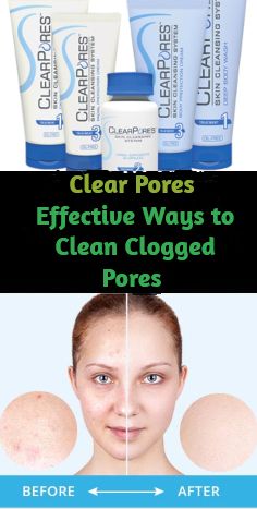 ClearPores is not just “one” acne item. Rather, it is a whole multi-component anti-acne and also skin-care system that consists of 3 basic actions #skincare #acne #clearpores Skincare Acne, Skin Care System, Clogged Pores