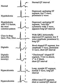 Use for homework assignment Ekg Leads, Cardiac Rhythms, Nursing Information, Nursing Cheat, Pa School