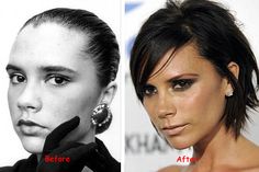 Victoria Beckham has never shied away from plastic surgery, so it's no surprise that she had a nose job. Before the surgery, her nose was actually bulbous and big. Bulbous Nose Rhinoplasty, Nose Rhinoplasty, Posh Spice