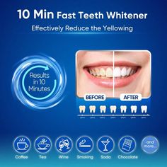 Color:Blue \n Teeth Whitening Gel, Smile Teeth, White Smile, Whitening Kit, Teeth Whitening Kit, Sensitive Teeth, Teeth Whitening, Color Blue, Free Shipping