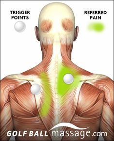 Referred pain is the defining symptom of a myofascial trigger pointMany of our clients come to us after receiving a diagnosis from an MD. Despite the rise in interest an Massage Anatomy, Punkty Spustowe, Psoas Release, Referred Pain, Trigger Point Therapy, Trigger Point, Foot Reflexology, Neck Pain Relief, Neck And Shoulder Pain