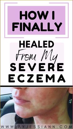 Sharing how I found relief and healed my severe excema. Includes how to get eczema under control, eczema remedies, and excema relief tips. #skincare #healingjourney #eczemarelief #selfcare #wellness Excema Relief, Itchy Skin Remedy, Rash On Face, My Healing Journey, Severe Dry Skin, Natural Remedies For Migraines, Wellness Selfcare, Dry Skin Remedies, Sensitive Skin Care