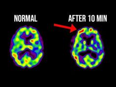 normal and after brain mri images