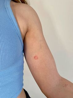 a woman's arm with red spots on it, showing the area where she has been bitten