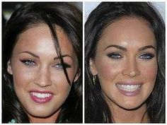 Veneers Before And After, Celebrities With Veneers, Perfect White Teeth, Celebrity Teeth, Dental Makeover, Dental Decay, Celebrity Smiles, Veneers Teeth, Beautiful Teeth