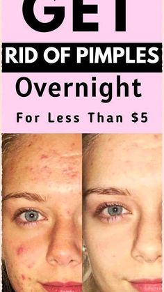 How To Get Redness Out Of Pimples Fast, How To Heal Popped Pimples Fast, Get Rid Of Bumps On Face, Breakouts On Face Remedies, Pimples On Face Meaning, How To Get Rid Of Pimples Overnight, Pimple Remedies Overnight, Hard Pimple, Pimple Remedies