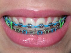 Beautiful Smiles can be BOLD, FUN, & COLORFUL! #braces -- Curated by: Dr Stephen T E Malfair Inc. | Suite 301-1890 Cooper Rd, Kelowna, BC V1Y 8B7, Canada | 250-860-8900 Braces Colours, Braces Retainer, Braces Girls