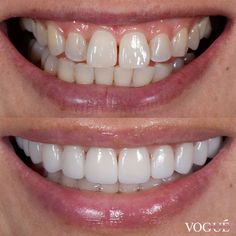 Teeth Goals, Aesthetic Smile, Teeth Whitening Methods, New Teeth, Dental Aesthetics, Dental Videos