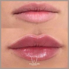 Lip Injections Natural Look, Good Lip Filler Pictures, Lip Filler For Hydration, Light Lip Injections, Simple Lip Fillers, Before And After Lip Fillers Small Lips, Soft Lip Filler, Different Types Of Lip Fillers, Lip Injections Shapes Before And After