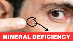 Lack of This Mineral Is Causing Your Age Spots Dr Burg, Mineral Deficiency, Mole Removal, Younger Skin, Facial Exercises, Natural Therapy, Acne Remedies, Face Yoga, Skin Care Remedies