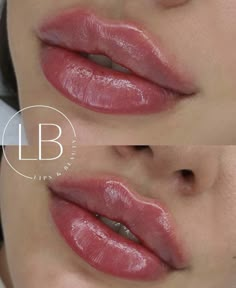 Lip Fillers Juvederm, 1ml Lip Filler, Stunning Makeup Looks, Lips Inspiration, Botox Lips, Earthy Vibes, Facial Fillers, Facial Aesthetics, Lip Filler