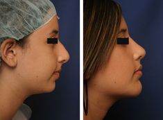 Chin Surgery, Rhinoplasty Before And After, Facial Proportions, Skin Needling