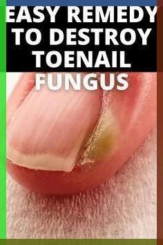 WITHOUT Painful Treatments or Costly Prescriptions. My Wife is Just as Relieved! Fungal Infection Remedies, Toenail Fungal Infection, Nail Remedies, Fingernail Fungus, Toenail Fungus Remedies, Nail Fungus Remedy, Fungal Nail, Ingrown Toe Nail, Toenail Fungus