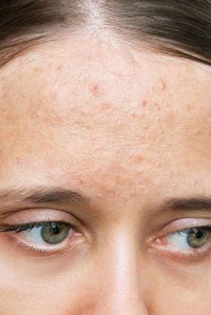 We asked dermatologists what is comedonal acne and the best comedonal acne treatments. Types Of Acne On Face, Doxycycline For Acne Before And After, How To Get Rid Of Closed Comedones, Calcium Deposits On Face, Closed Comedones, Comedonal Acne